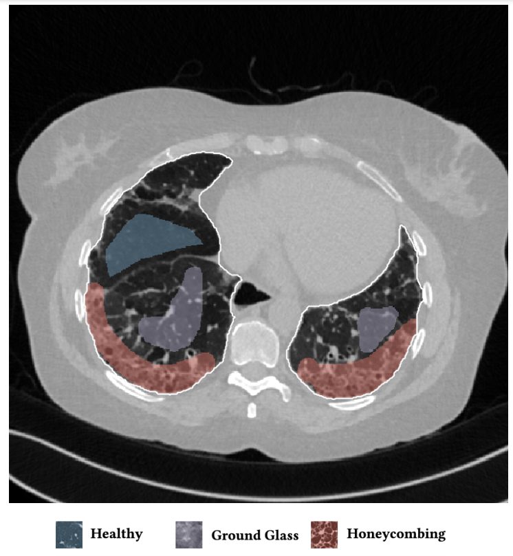 Example of an annotated HRCT lung scan