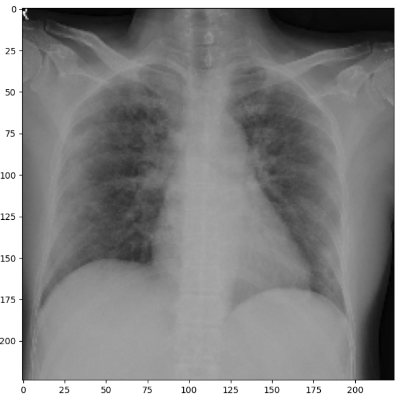 Chest X-Ray input image